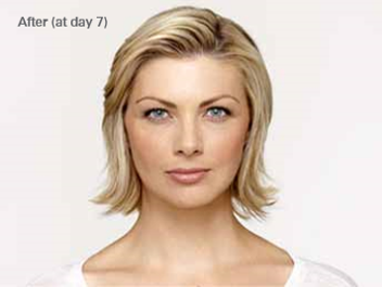 After Botox treatment