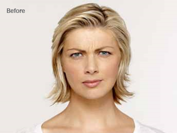 Before Botox treatment