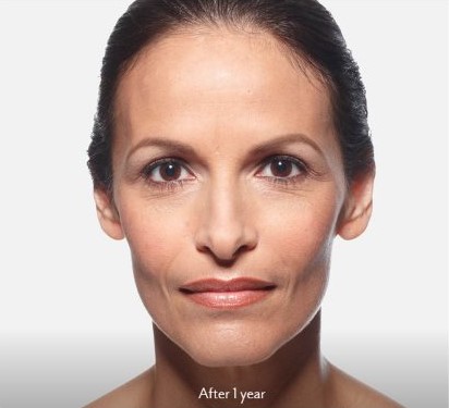 After juvederm treatment
