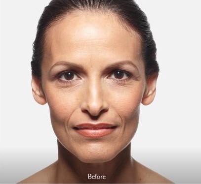 Before juvederm treatment