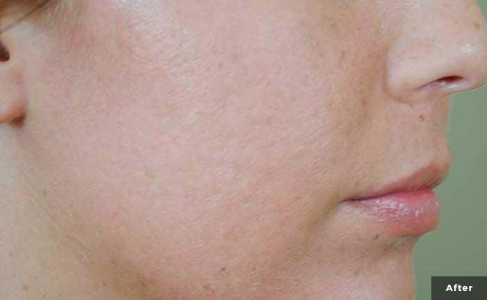 After laser treatment