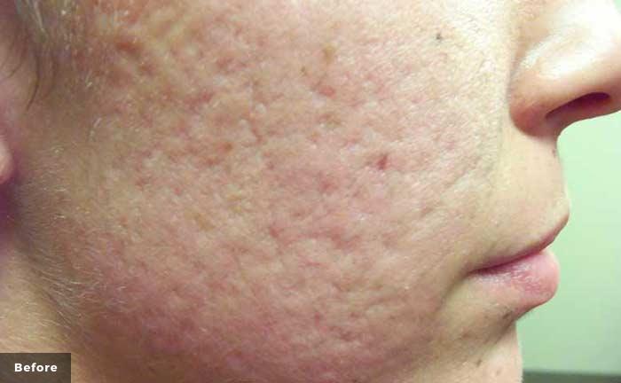 Before laser treatment